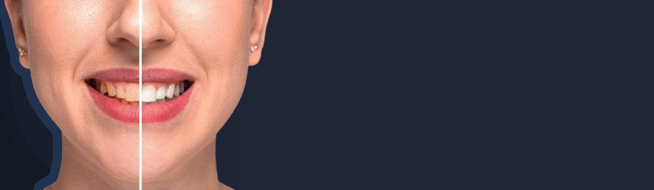 Teeth Whitening in İstanbul, Turkey