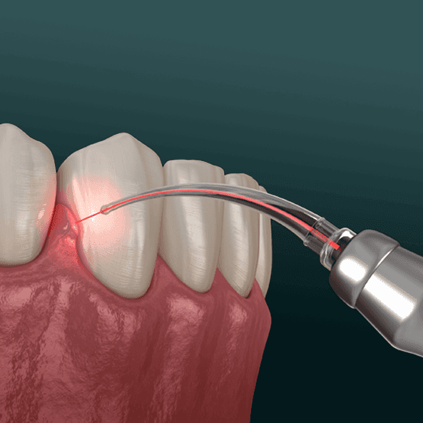 Laser Dentistry.png