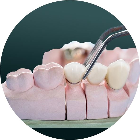 Dental Bridges2.png