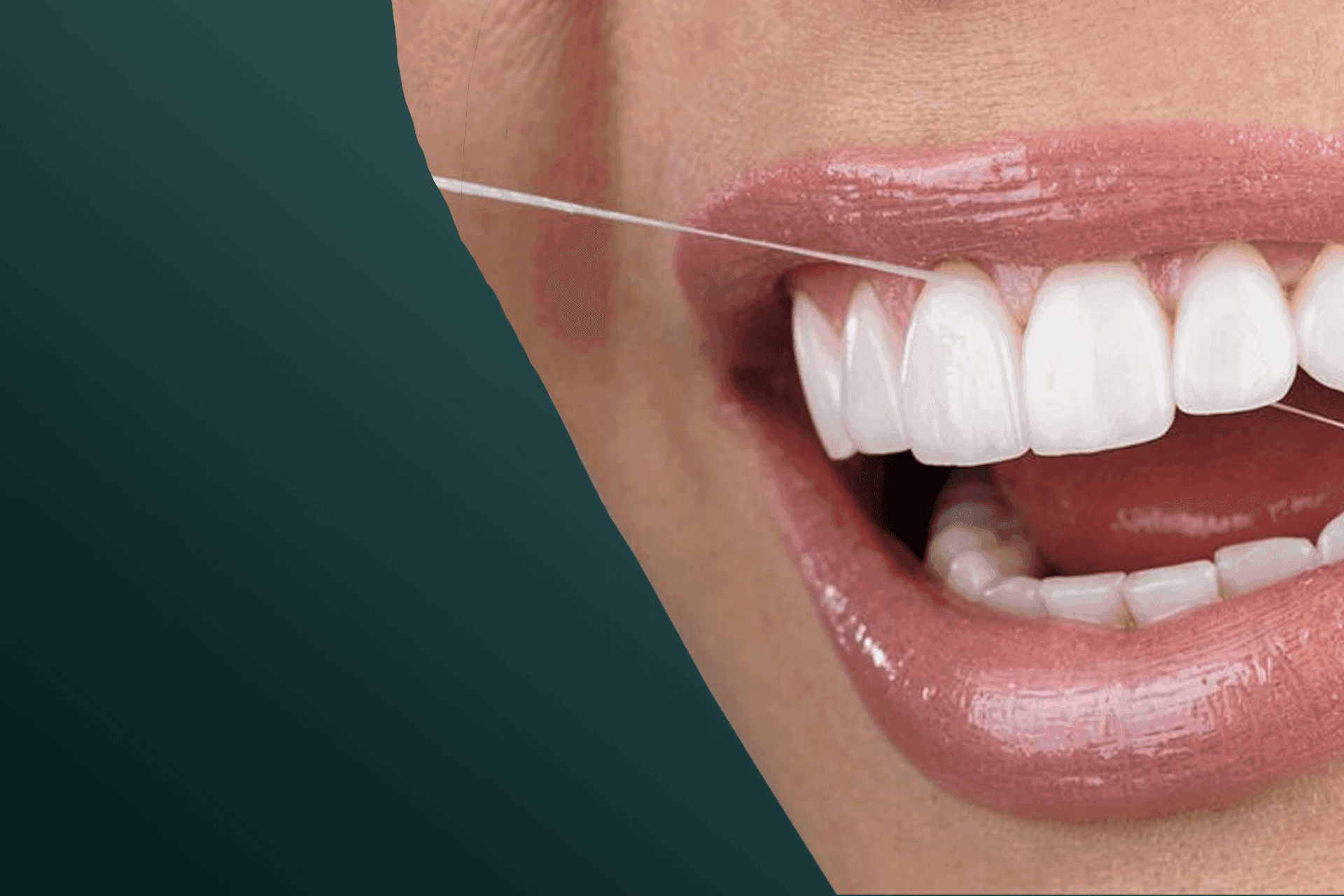 Veneer4-min.png