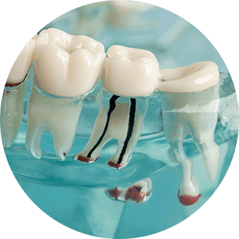 Root Canal-1.png
