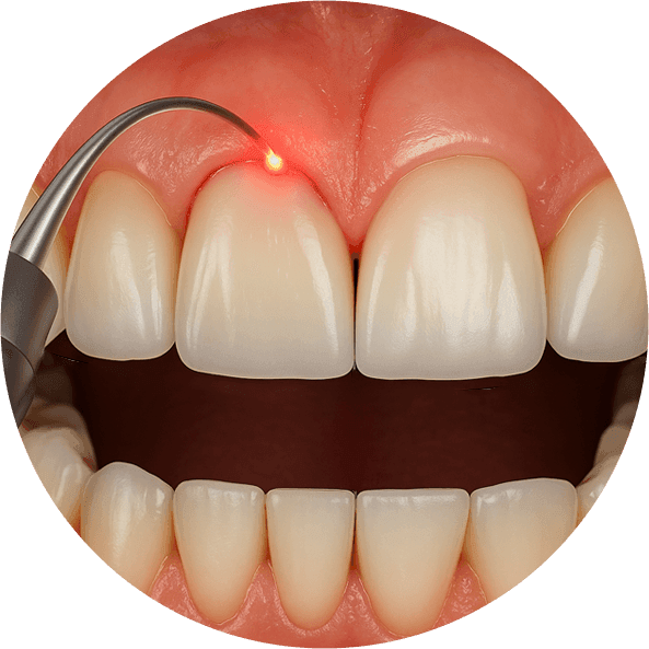 Gingivoplasty.png