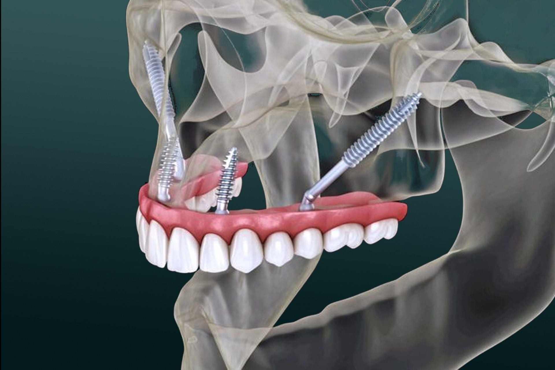Zygomatic Implants-03-compressed.jpg